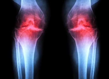 آرتروز،اخبار پزشکی،خبرهای پزشکی