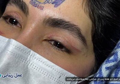 بهترین عمل‌های زیبایی با دوره نقاهت کوتاه برای انجام قبل از عید