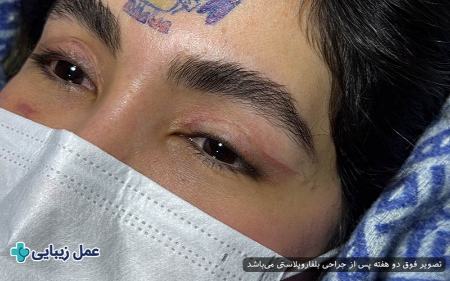 بهترین عمل‌های زیبایی با دوره نقاهت کوتاه برای انجام قبل از عید