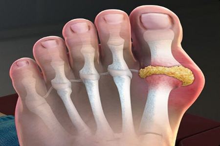 نقرس،اخبار پزشکی،خبرهای پزشکی