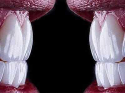 لمینت برای چه دندان هایی مناسب نیست؟ (بررسی 6 مورد ممنوعه + جایگزین‌ها)