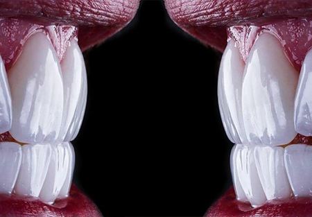 لمینت برای چه دندان هایی مناسب نیست؟ (بررسی 6 مورد ممنوعه + جایگزین‌ها)