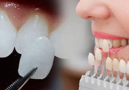 آیا کاندید مناسبی برای لمینت دندان هستید آیا کاندید مناسبی برای لمینت دندان هستید