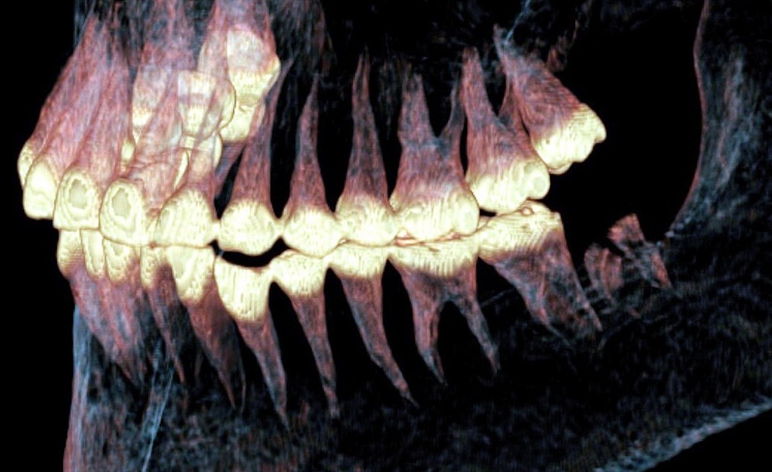 پروتز فک در ۲۵۰۰ سال پیش؛ شواهدی تازه از جراحی در میان سکاها
