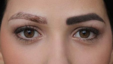 عوارض پاک کردن تاتو ابرو با لیزر {5 عوارض مهم و تجربی}